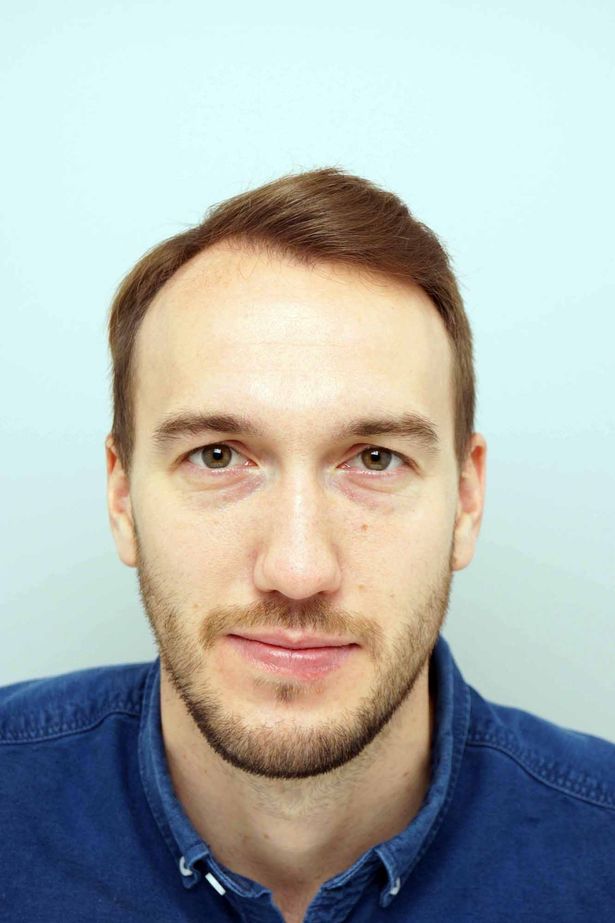 英国球星鲁尼植发,鲁尼植发真实视频