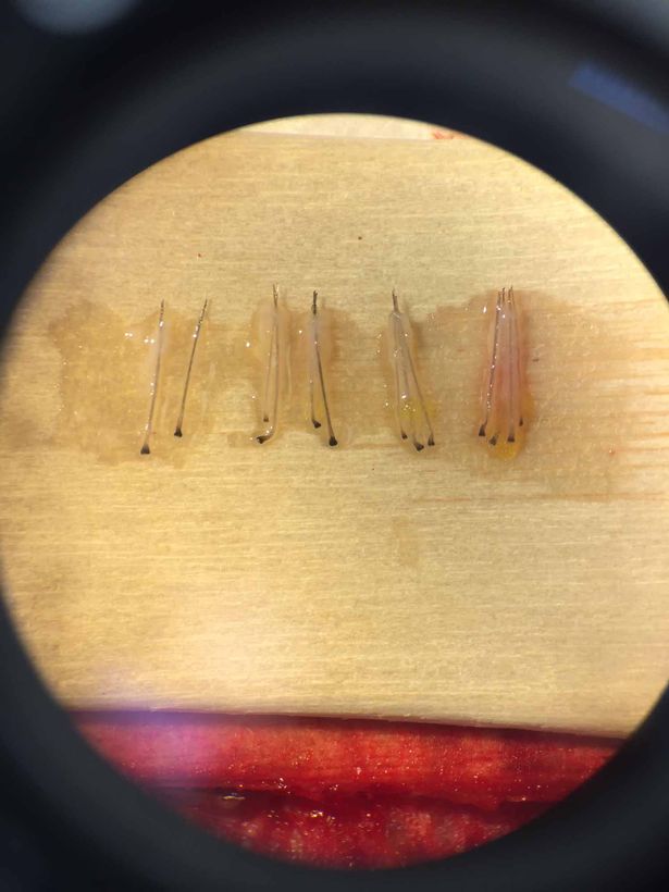 英国球星鲁尼植发,鲁尼植发真实视频