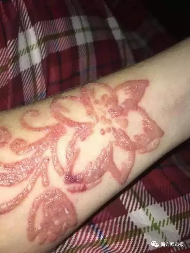 这样的文身，女孩涂后红疹起泡留疤都来了，你还敢玩吗？