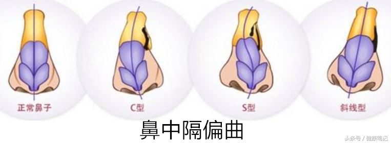 洗鼻有效果吗,洗鼻多久可以治愈鼻炎