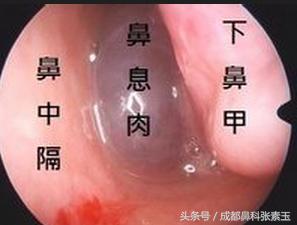 鼻息肉术后还有息肉怎么办,鼻息肉术后怎样恢复