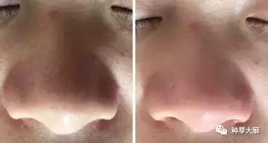 美容仪器小气泡有什么用,美容院小气泡仪器新款