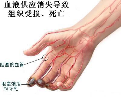 男子抽20年烟三根脚趾坏死,男子抽烟20年脚趾坏死