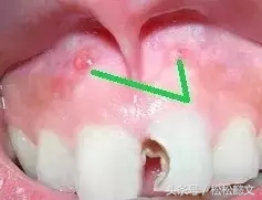 蛀牙为什么要治很多次,牙齿蛀牙高发如何有效预防和治疗