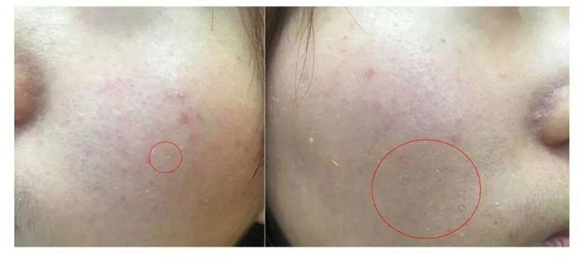 激素依赖性皮炎怎么算彻底修复好,激素依赖性皮炎裸脸会自愈吗