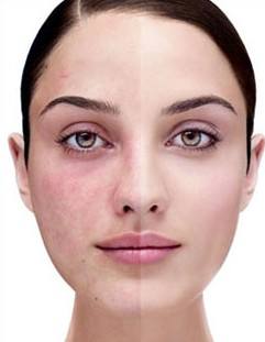 化妆品中含有激素对皮肤的损害,化妆品含有激素的原因