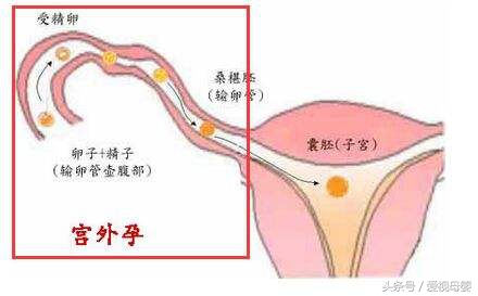 早孕试纸两条杠b超显示不出来,早孕试纸两道杠但是做b超看不到