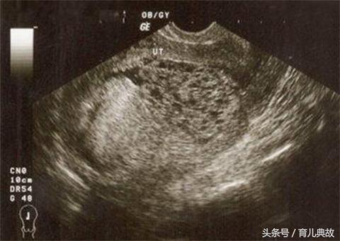 怀孕五月却检查出葡萄胎，这种心痛有谁能懂？