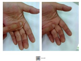 屈指肌腱鞘炎病历,屈指肌腱鞘炎