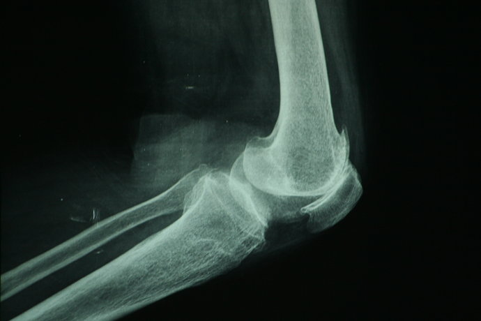 膝关节炎临床治疗讲座,膝骨关节炎中医诊疗指南解读