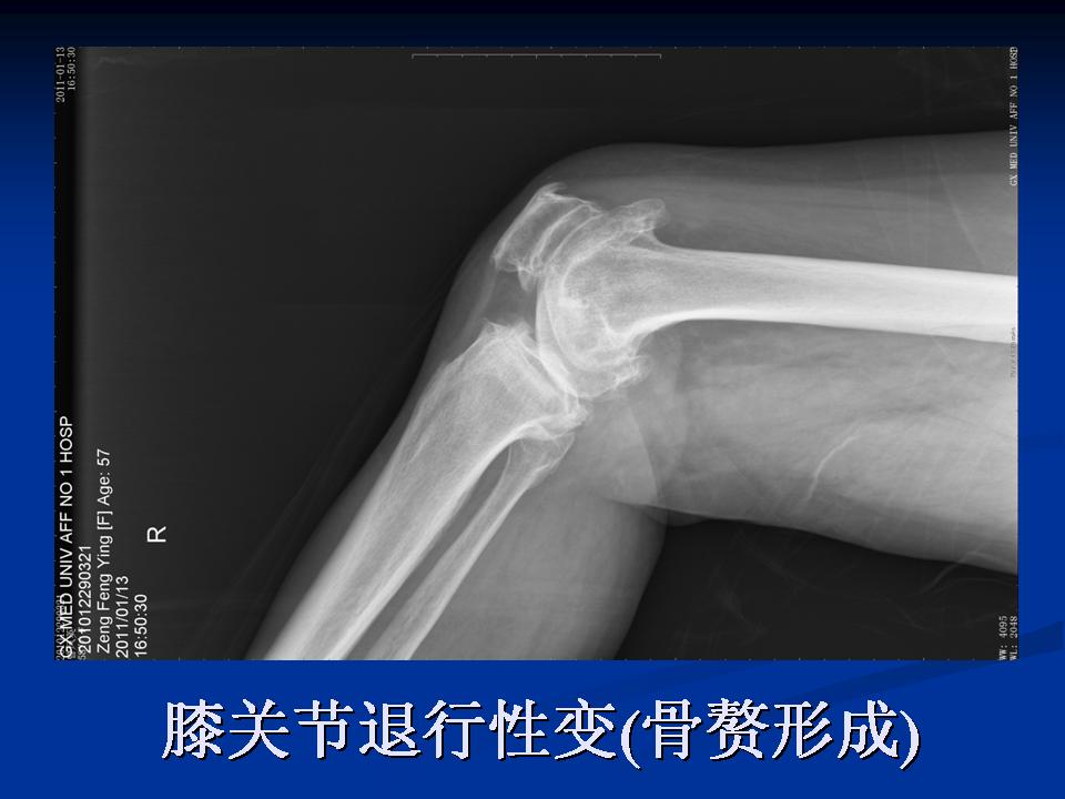 膝关节骨性关节炎的阶梯治疗课件,膝关节炎的非手术疗法