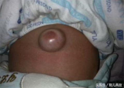 一个月的宝宝肚脐上有点鼓,两个月宝宝肚脐凸起按压有水声