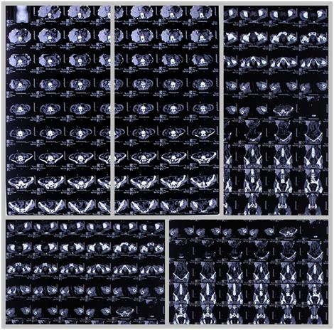 骶骨神经源性肿瘤是什么,骶管囊肿与神经源性肿瘤鉴别