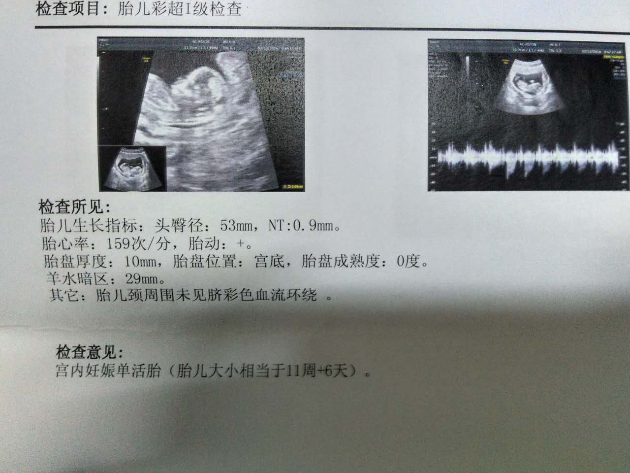 39周顺产的胎宝宝,孕39周想顺产的妈咪关注事项
