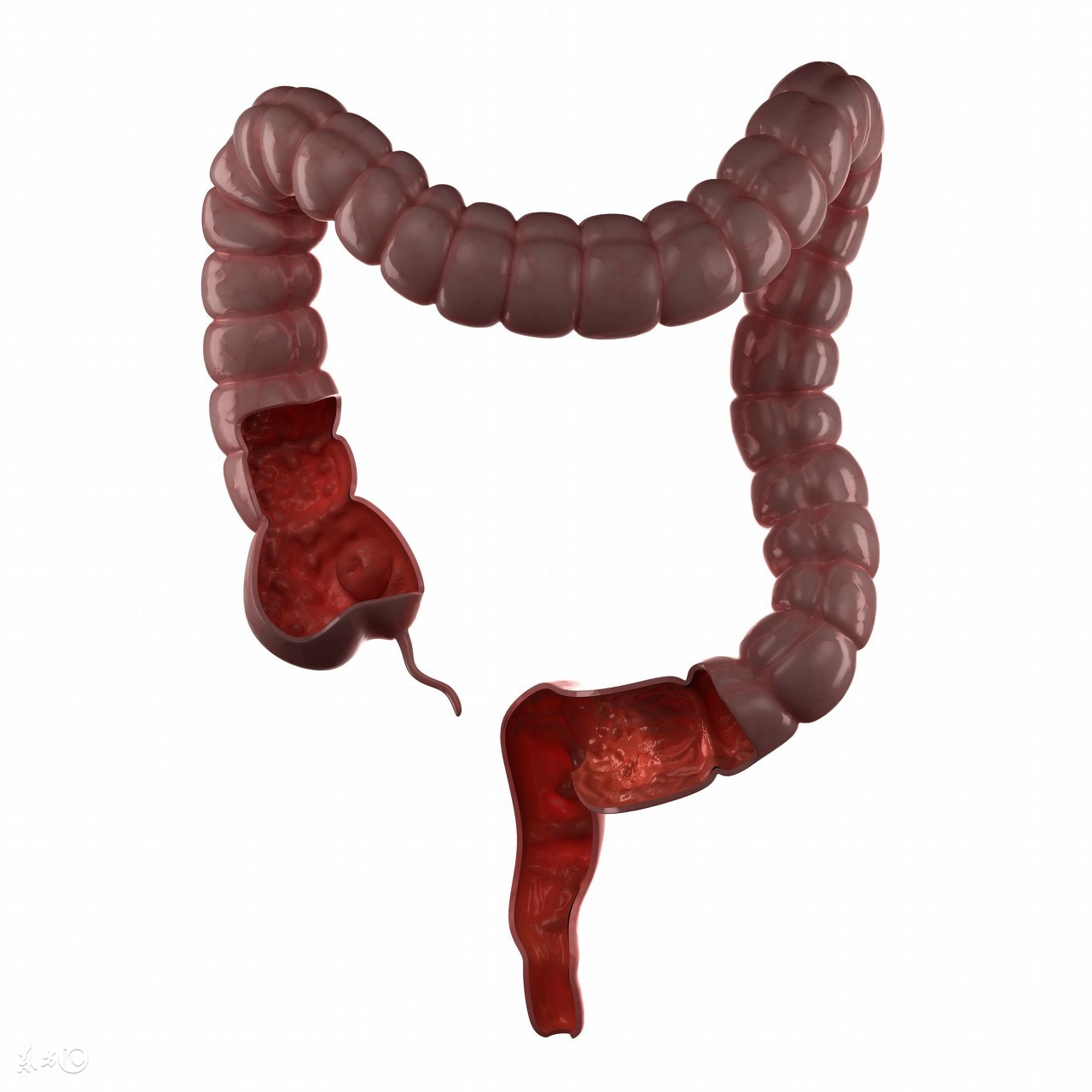 得了结肠炎怎样治疗,得了溃疡性结肠炎