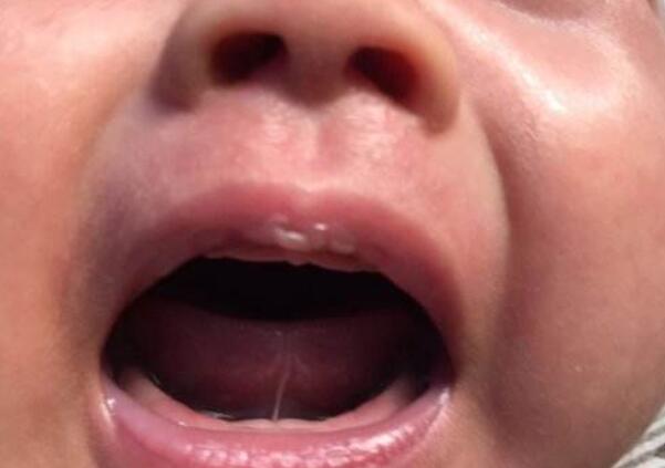 宝宝舌头w型是舌系带短吗,宝宝舌头w型一定要做手术吗