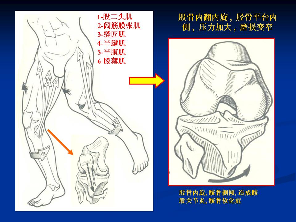 膝关节骨性关节炎的阶梯治疗课件,膝关节炎的非手术疗法