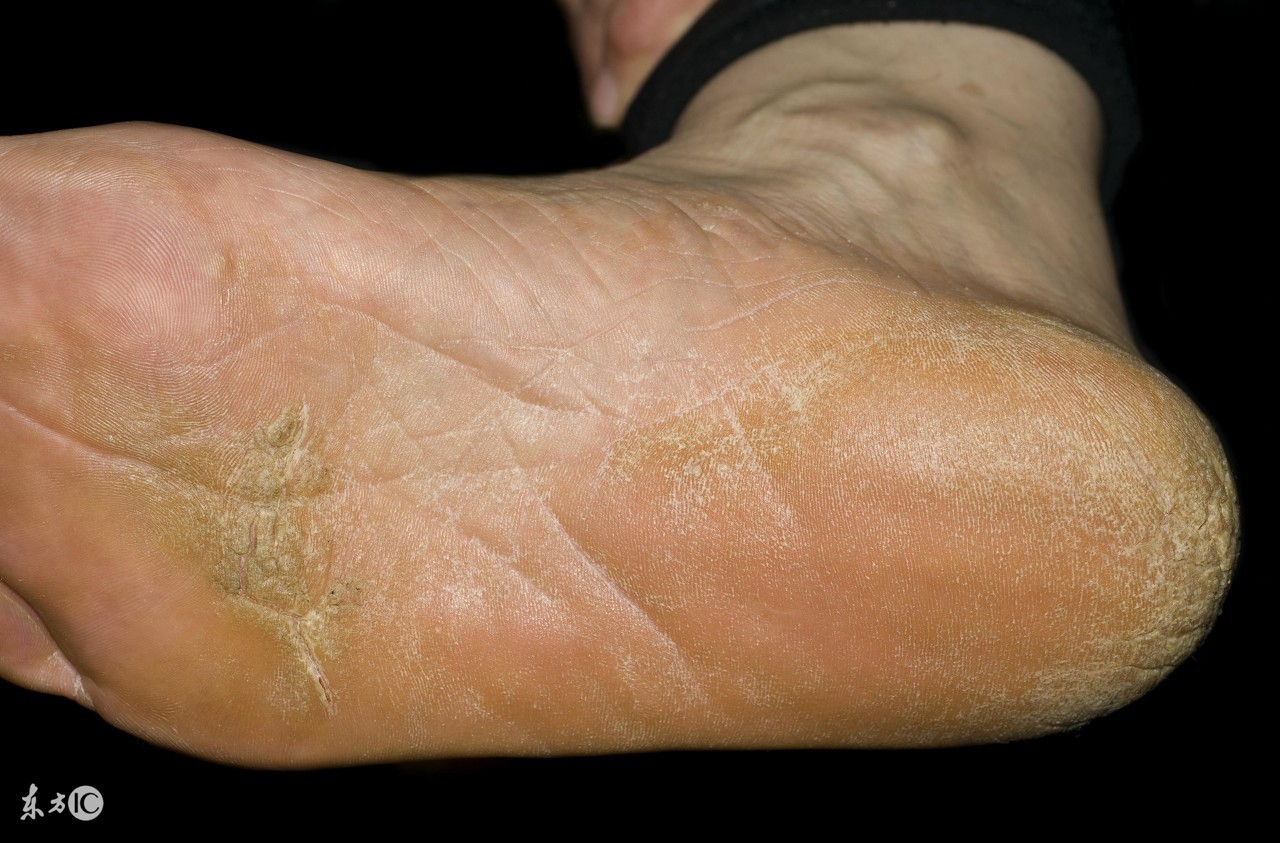 下雨天香港医院,下雨天香港脚能治好吗