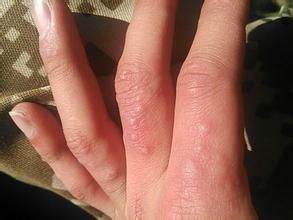 冬天手痒里面有小水泡加脱皮,中医手上起小水泡很痒怎么办