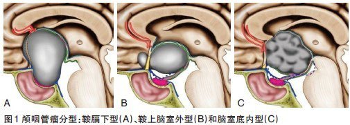 绕过这些弯路，治疗颅咽管瘤没那么难