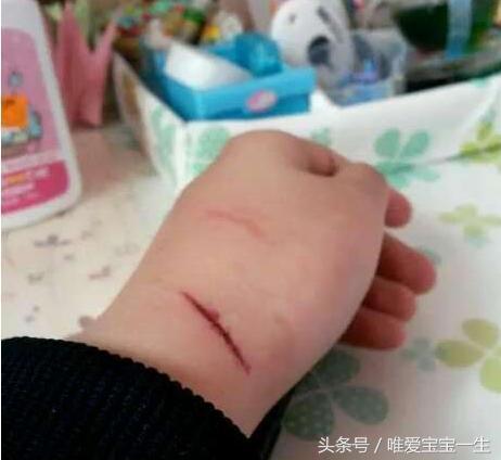 宝宝缺锌需要做哪些检查,一岁三个月宝宝缺锌自测表