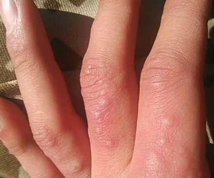 用什么方法治湿疹不再犯,治湿疹天然方法