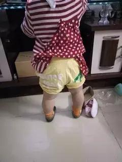 宝宝穿纸尿裤腿上有勒痕是小了吗,纸尿裤会导致o型腿吗