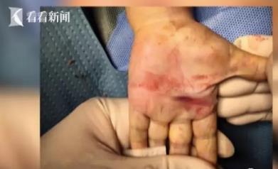 在手上扎针是不是可以治小孩挑食,小孩扎手指头治积食