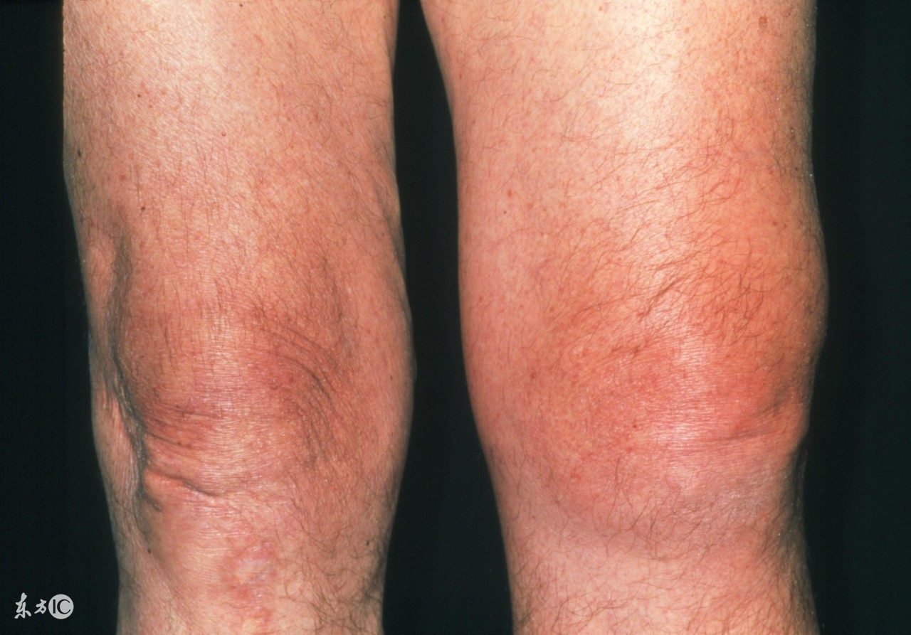 走路老是腿打弯是怎么回事,走路腿打软能治好吗