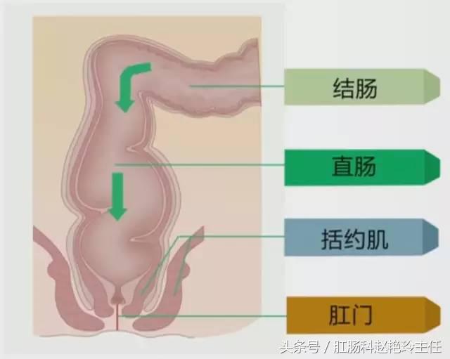 肛瘘是怎么回事？肛瘘是由什么原因造成的
