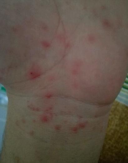 用什么方法治湿疹不再犯,治湿疹天然方法