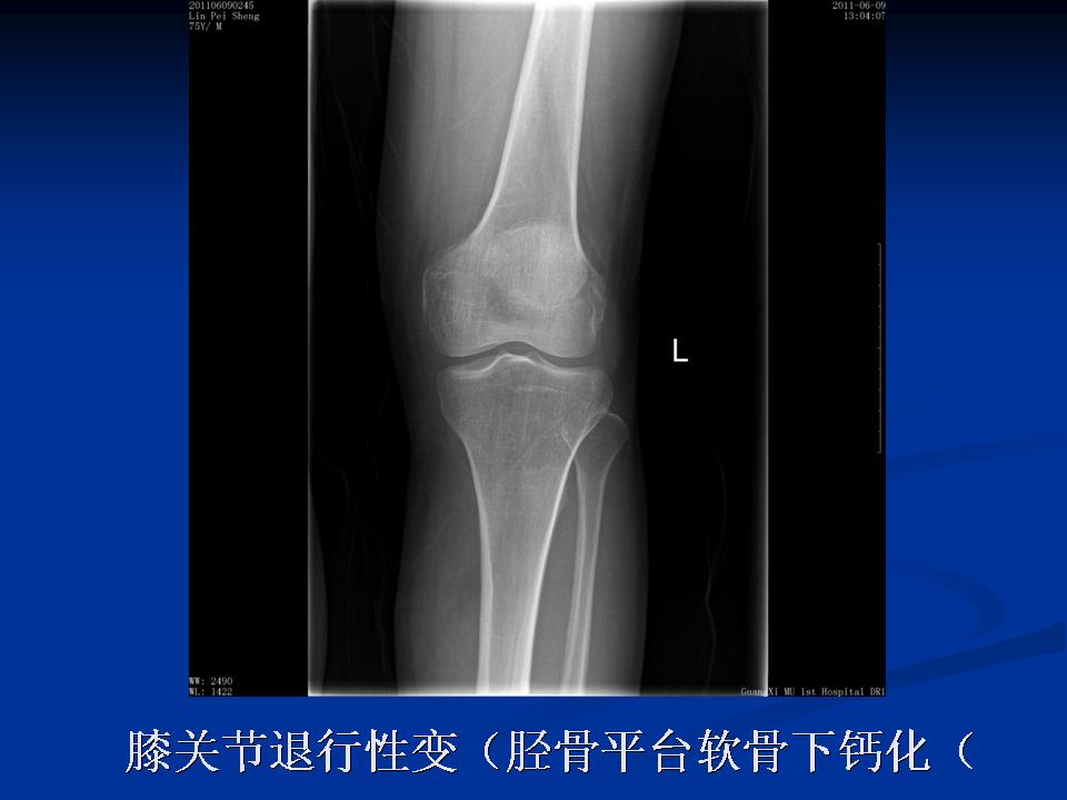 膝关节骨性关节炎的阶梯治疗课件,膝关节炎的非手术疗法