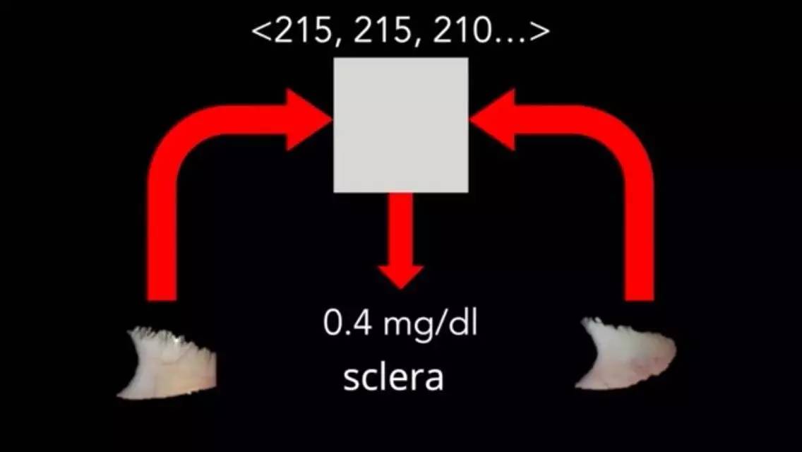 美国华盛顿大学开发出新款APP：通过智能手机自拍筛查胰腺癌！