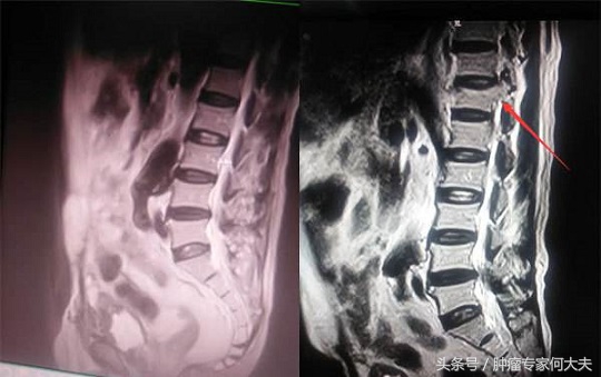 肺癌骨转移活了10年,肺癌脑转移骨转移活了10年