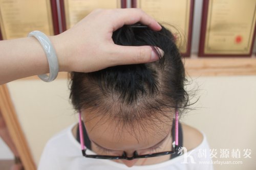 发问｜植发是选择植发机构还是三甲医院？