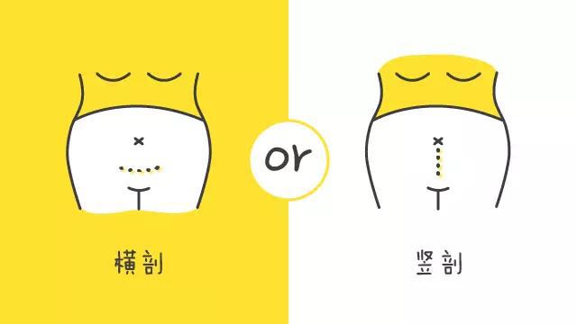 分娩应该选择剖腹产还是顺产呢,顺产和剖腹产必选的几个选项