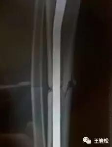骨折术后怎么长得快,骨折为什么长得那么慢