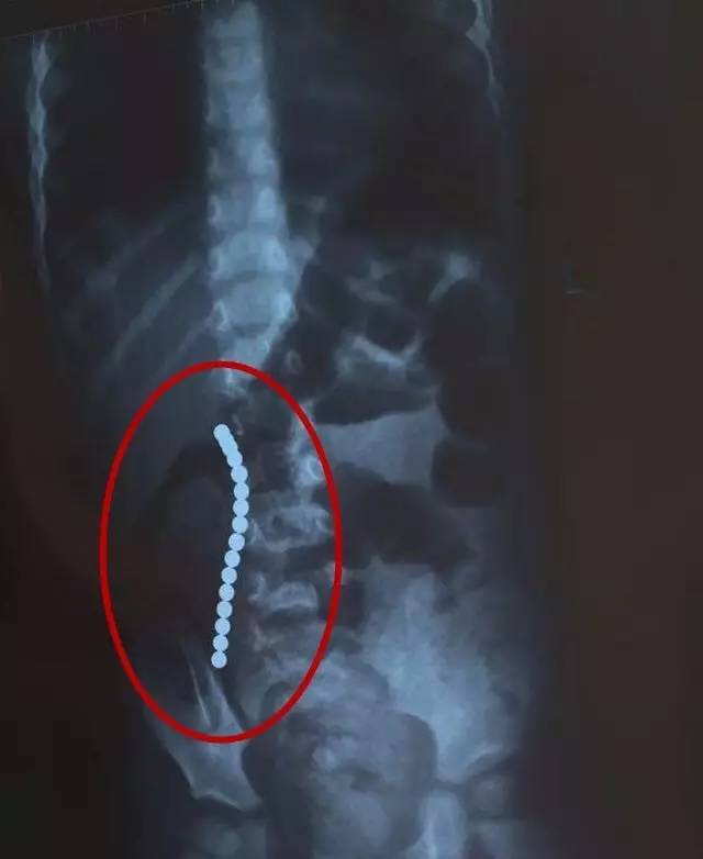 玩完玩具后肚子疼,小孩玩具珠子吞进肚子了