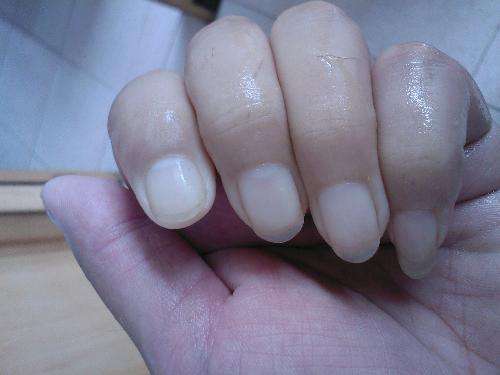 看双手就知道贫血与否！贫血只需补一种营养