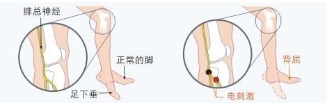 足下垂治疗成功案例,小孩足下垂是什么原因