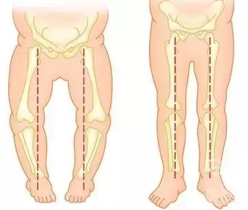 宝宝穿纸尿裤腿上有勒痕是小了吗,纸尿裤会导致o型腿吗