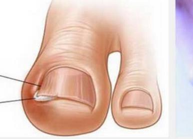 治疗灰指甲被骗一万多,治疗灰指甲的亲身经历