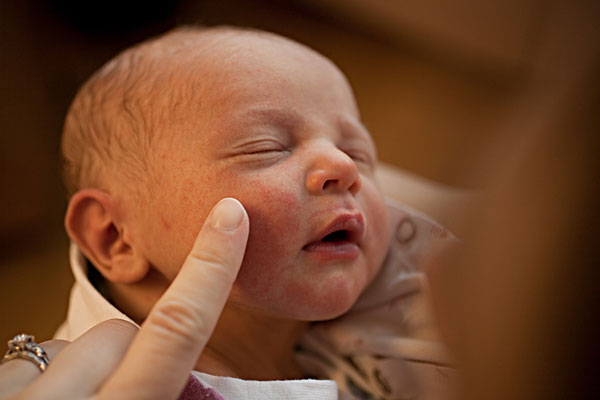 宝宝湿疹的最佳治疗方法干性湿疹,孩子湿疹反反复复怎么根除好