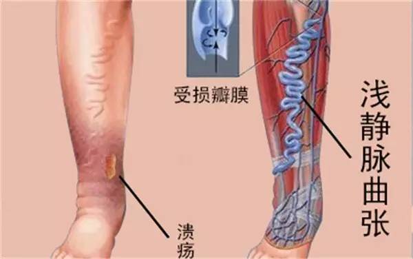 腿上长了这种包千万别瞎挤，谨慎猝死找上你！