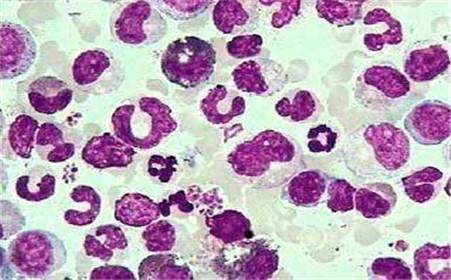 过敏性紫癜是用中医还是西医,过敏性紫癜西医治好还是中医治好