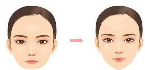 了解下丰胸的含义是什么,隆下巴科普