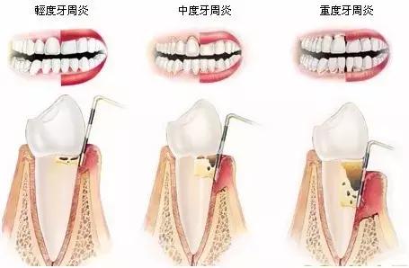 牙龈萎缩牙根暴露该怎么治疗啊,牙龈萎缩牙根暴露怎么办
