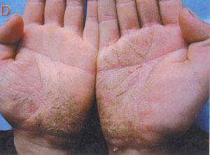 湿疹的根源在哪里怎样才能根治,湿疹怎么治疗不留后遗症