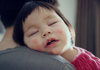 婴儿对牛奶过敏喝什么奶粉,宝宝奶粉过敏的识别和处理