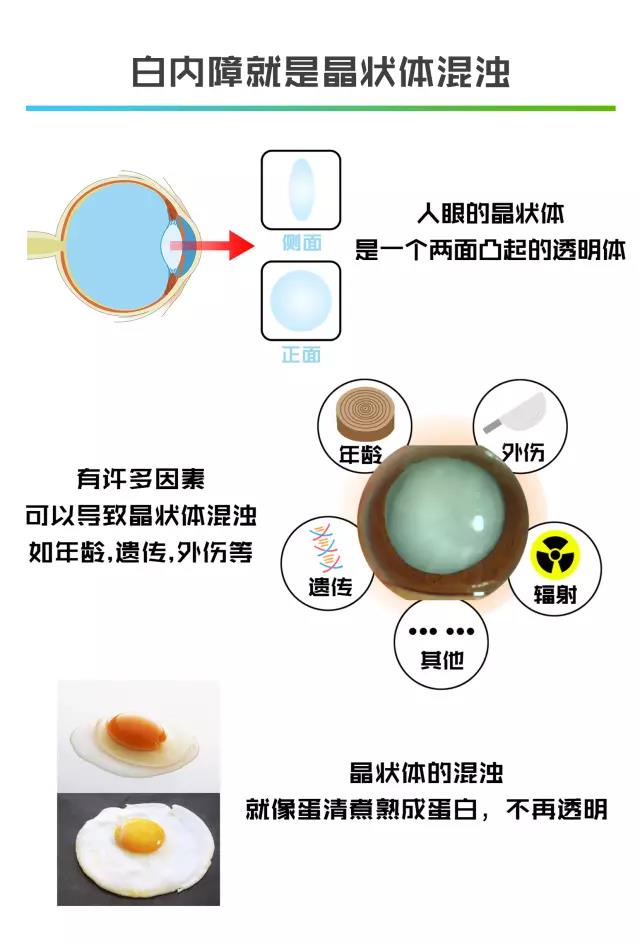 〖周二银海爱眼课堂〗飞秒激光加超声乳化，白内障拜拜！